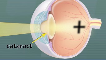 Staywell Cataract Video