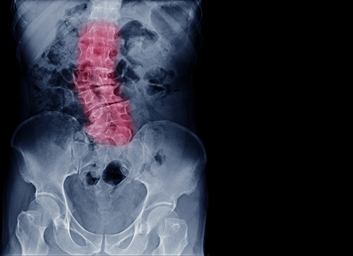 Scoliosis has many faces and treatments | OSF HealthCare Blog