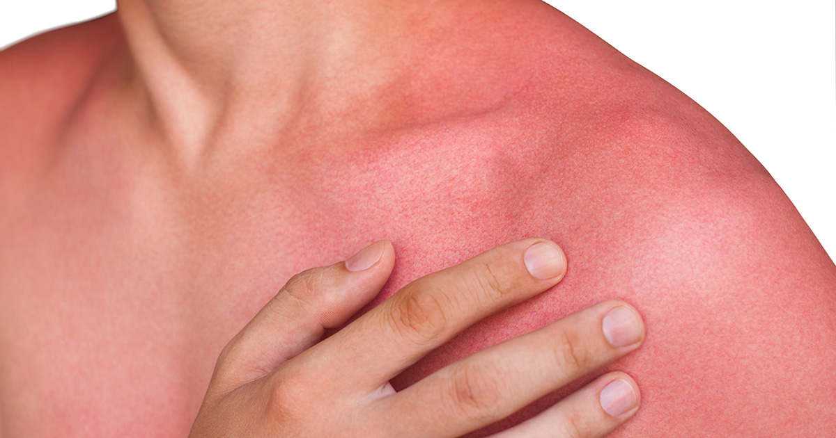Heat Rash Symptoms, Treatment, and Prevention 