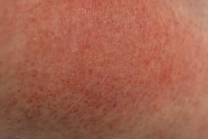 Heat rash, sun rash -- what's the difference?