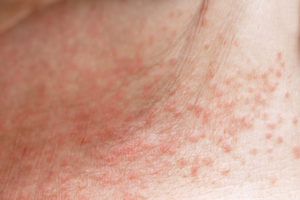 What is causing my rash along my armpits, joints, and groin? I