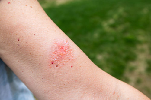 How to treat poison ivy or oak | OSF HealthCare