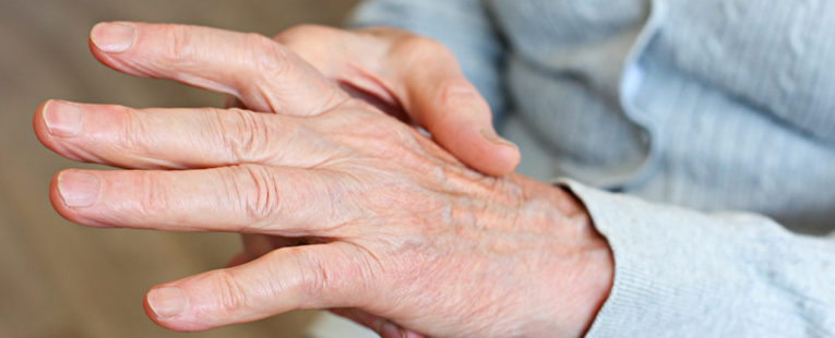 Don-t Lose Your Grip- Rheumatoid Arthritis and Grip Strength