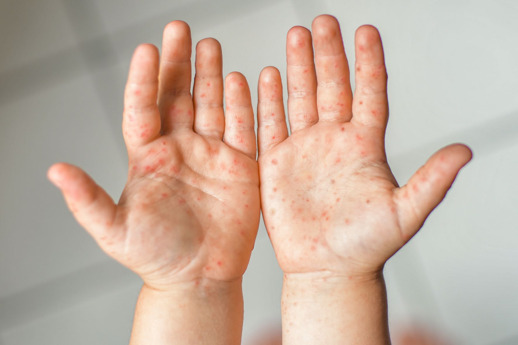 Does my child have hand, foot and mouth disease? | OSF HealthCare