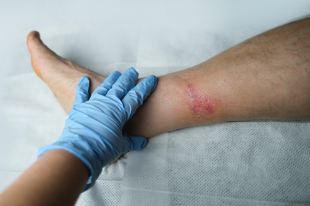 How to tell if a wound is healing or infected | OSF HealthCare